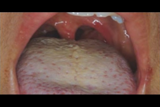 halitosis-coating-on-tongue jpg jpg