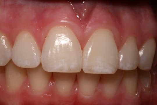 Mild-fluorosis jpg