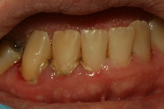 Supra and Subgingival Calculus jpg